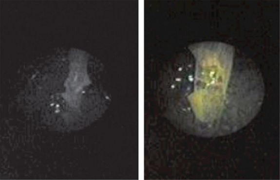 Immagine ottenuta tramite endoscopio (RSNA RadioGraphics)