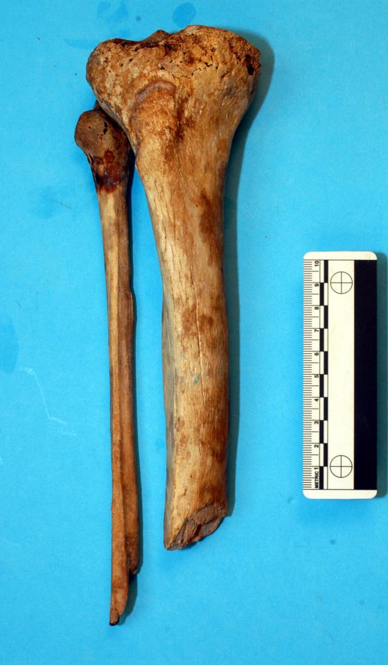 La tibia e la fibula di destra di Giovanni: sono evidenti i segni della ferita da arma da fuoco e dell’amputazione di maestro Abram (Università di Pisa)