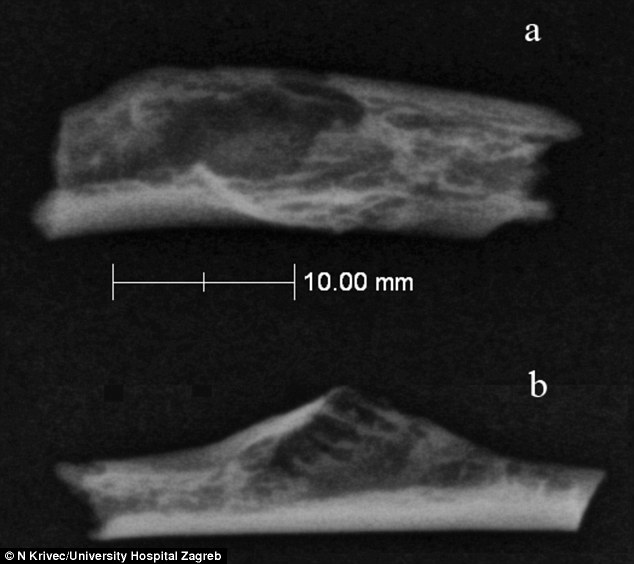 (University Hospital Zagreb)