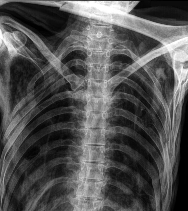 Raggi x del torace (Museo Archeologico dell’Alto Adige/Ospedale Regionale di Bolzano)