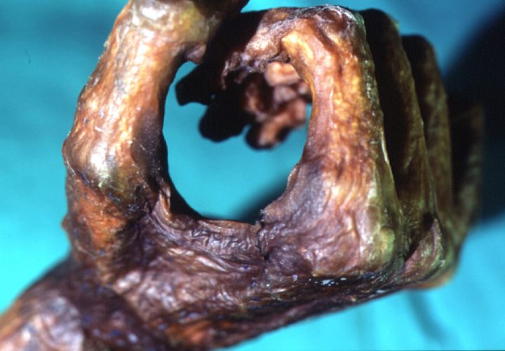 Ferita alla mano (Museo Archeologico dell’Alto Adige)